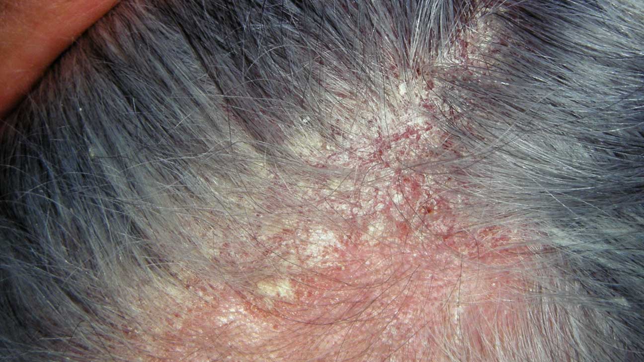 Bệnh ngứa da đầu là gì?